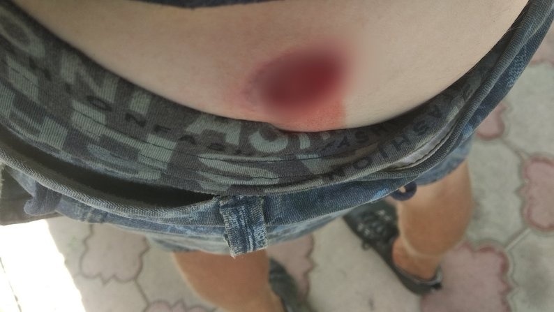 Слід від травматичного поранення, наданий Романом